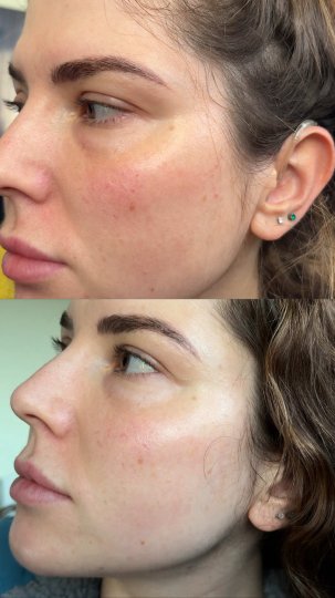 TikTok post by @mwinona777: 4 weeks of my @Shark Beauty Cryoglow mask! Video content: A before and after video…